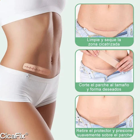 CicaFix® - Cinta De Silicona Para Cicatrizar