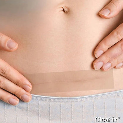 CicaFix® - Cinta De Silicona Para Cicatrizar