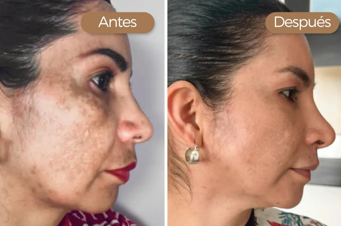 Pureskin® - Crema Facial Anti Manchas